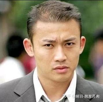 明星植發(fā)，頭頂新旅程與友情力量鑄就秀發(fā)重生