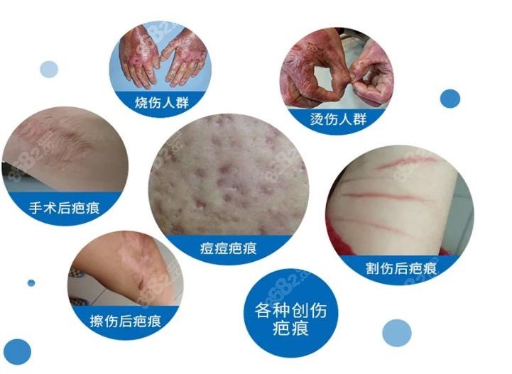 最新疤痕修復(fù)技術(shù)重塑肌膚之美，重塑肌膚的完美選擇