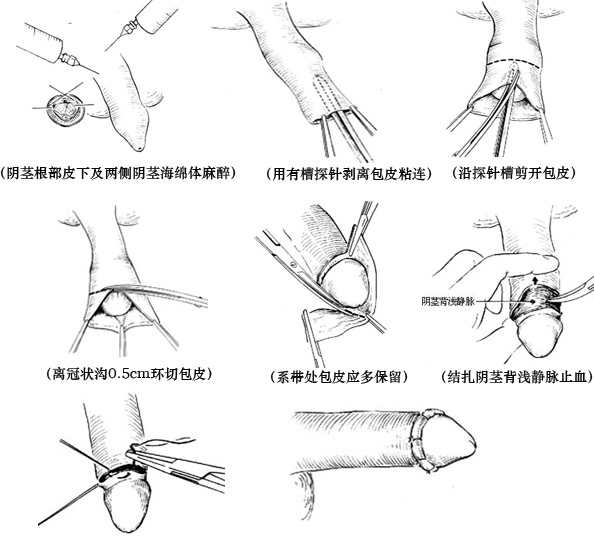 包皮手術(shù)創(chuàng)新技術(shù)引領(lǐng)健康生活新時代，科技之光重塑醫(yī)療領(lǐng)域